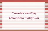 Czerniak złośliwy Melanoma malignum