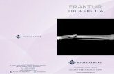 BROSUR FRAKTUR TIBIA FIBULA FA · PDF fileTitle: BROSUR FRAKTUR TIBIA FIBULA FA Created Date: 12/10/2015 9:24:55 AM