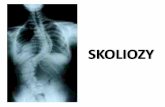 SKOLIOZY - Michał Ficoń · 2016-09-24 · powodującą zmiany w układzie narządu ruchu, oddechowym i krążenia. Jest to odchylenie osi anatomicznej kręgosłupa (wyznaczonej