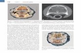 156 Część I Anatomia ogólna - Edra Urban & Partner · które oddziela jamę ustną od jamy nosowej. Szczegółowa budowa podniebienia twardego różni się znacznie w za-leżności