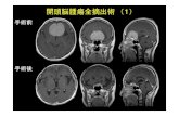 開頭脳腫瘍全摘出術（1） - IMS...開頭脳腫瘍全摘出術（2） 手術前 手術後