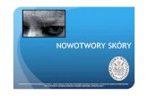 NOWOTWORY SKÓRY I INNE NOWOTWORY...W Polsce w 2006 roku zarejestrowano 2001(w 2000 r. - 1 601) zachorowańna czerniaka skóry oraz 1051 (w 2000 r. – 928) zgonów nim spowodowanych